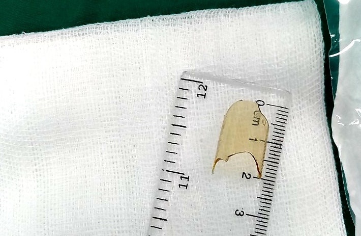 Be gai 8 thang tuoi thoat chet sau khi nuot manh vo thuy tinh hinh anh