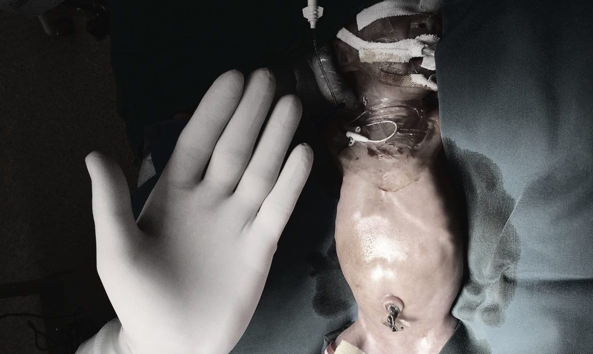 Ca phau thuat tieu hoa cho tre sinh non va nhe can nhat Viet Nam hinh anh