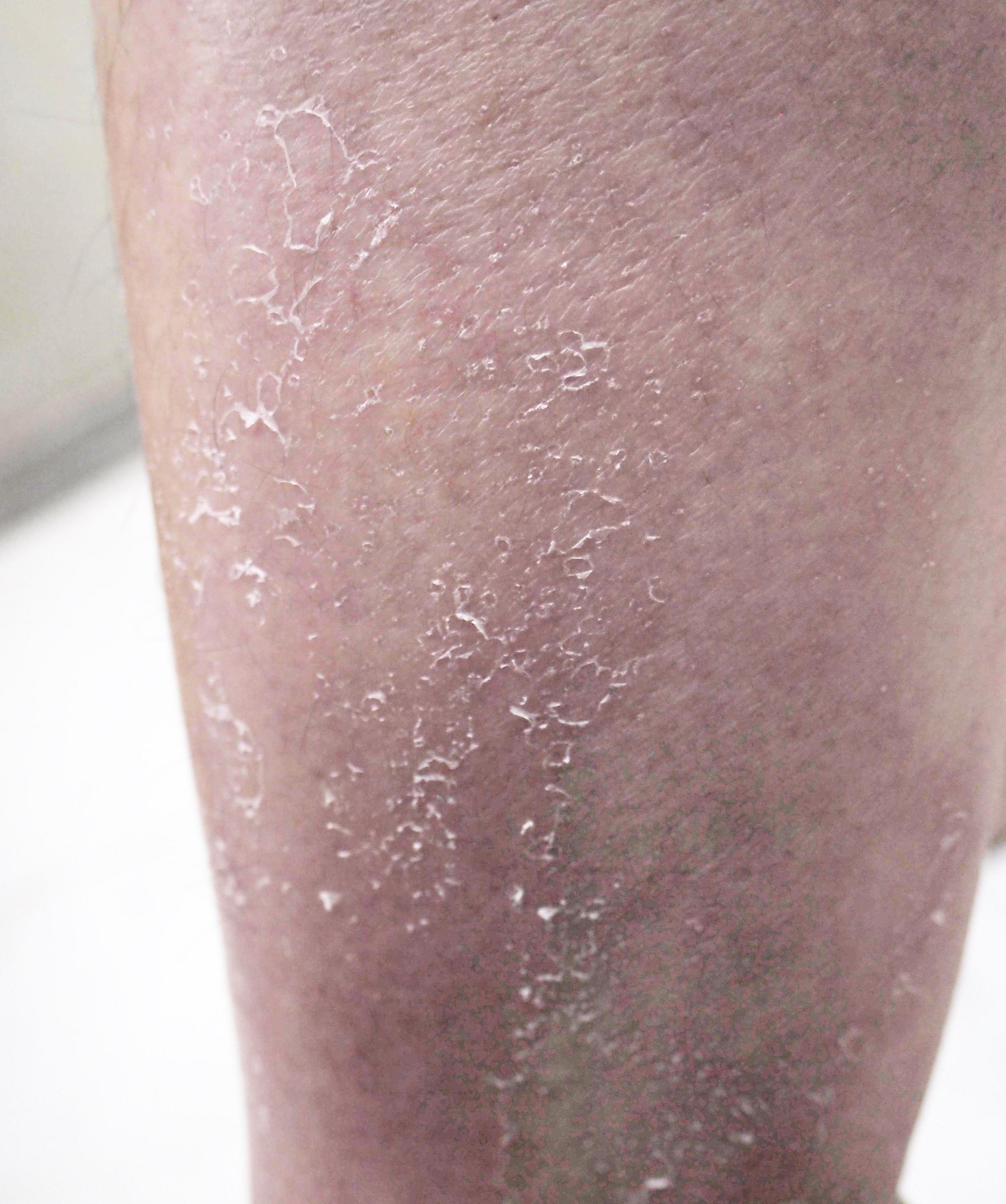 cham soc da mua nang anh 2