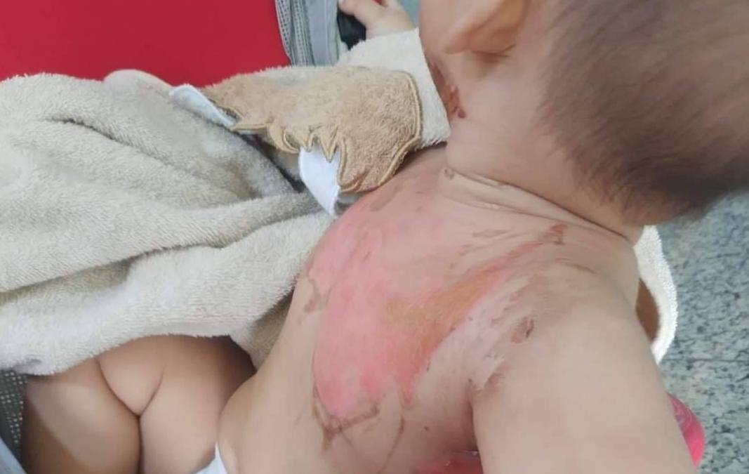 Be 2 tuoi bong nang do nghich nuoc soi nau mi tom hinh anh