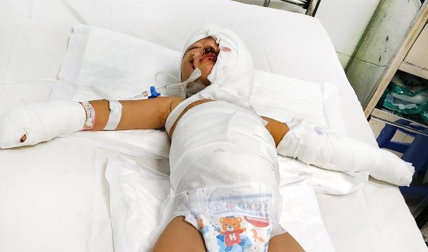 Hai be trai bong nang khi khu nha tro bi nem bom xang hinh anh