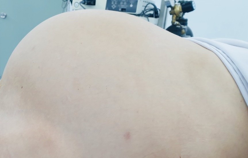 Mo khan cap lay khoi u to nhu thai 9 thang hinh anh