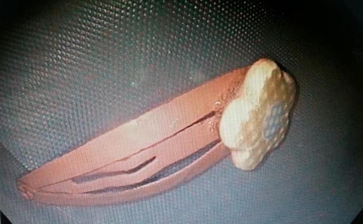 Be gai 13 thang thoat chet sau khi nuot kep toc hinh anh