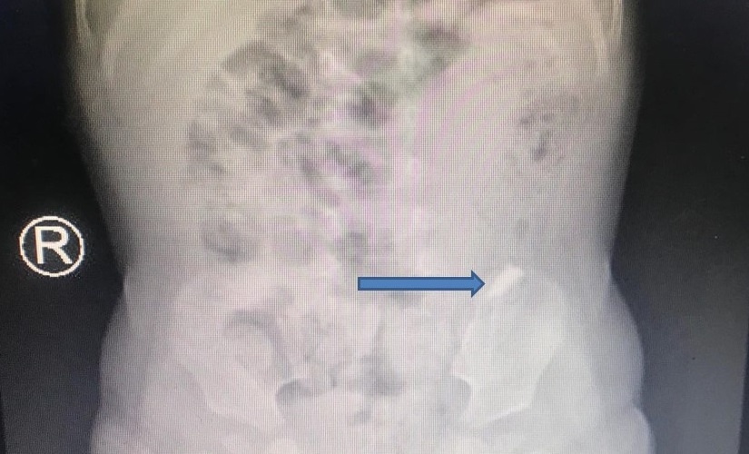 bé trai nuốt mảnh kính ảnh 1 be trai nuot manh kinh anh 1