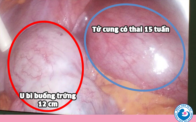 vua mang thai vua mang u buong trung anh 1