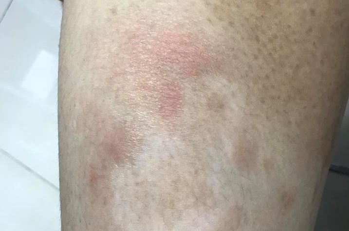 Nguoi phu nu mac ung thu da nhieu nam khong he hay biet hinh anh