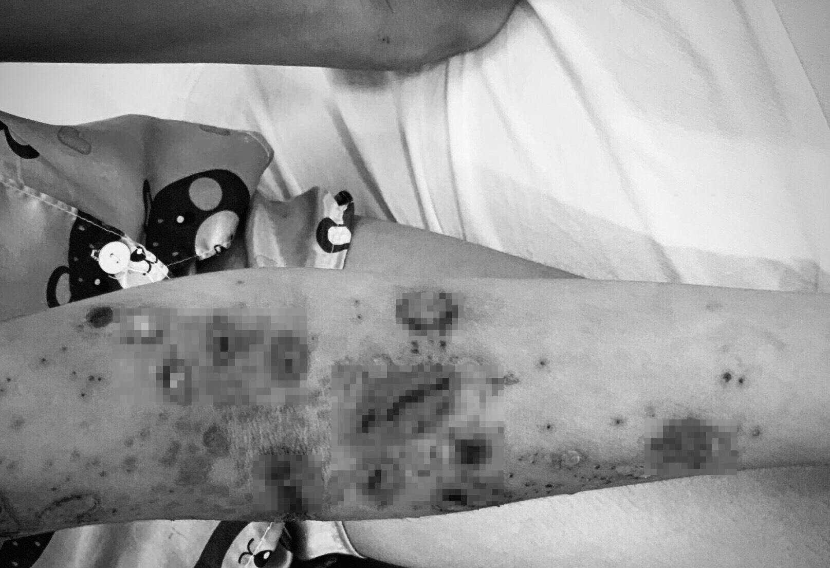 viem da tiep xuc do sua bien anh 1