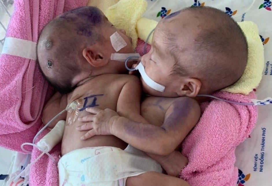 be gai song sinh dinh lien anh 1