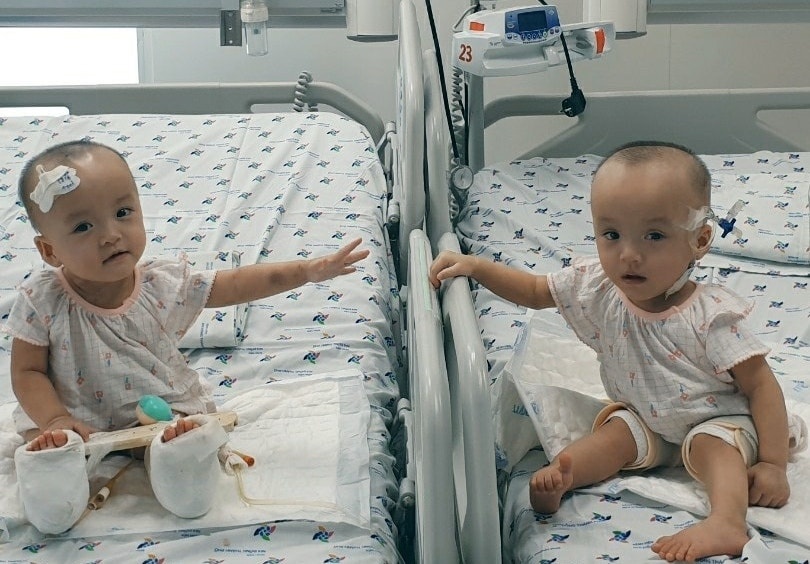 Song Nhi lan dau cham tay nhau sau ca mo tach roi hinh anh