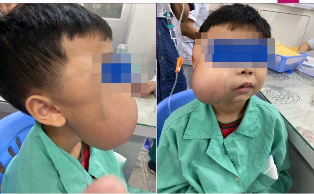 u xơ hàm mặt đầu tiên ở Việt Nam ảnh 1 u xo ham mat dau tien o Viet Nam anh 1