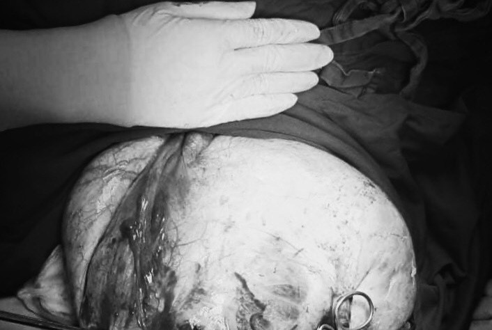 khối u buồng trứng nặng 12 kg ảnh 1 khoi u buong trung nang 12 kg anh 1