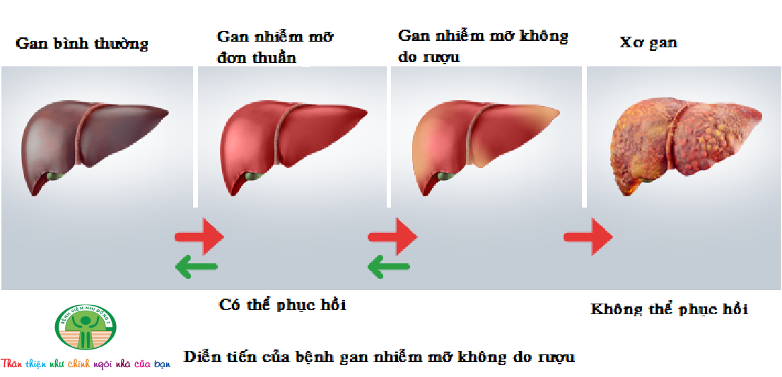 bé trai bị gan nhiễm mỡ ảnh 1 be trai bi gan nhiem mo anh 1