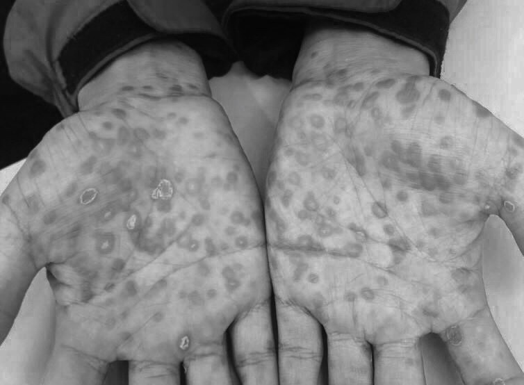 benh tinh duc khi quan he khong an toan anh 2