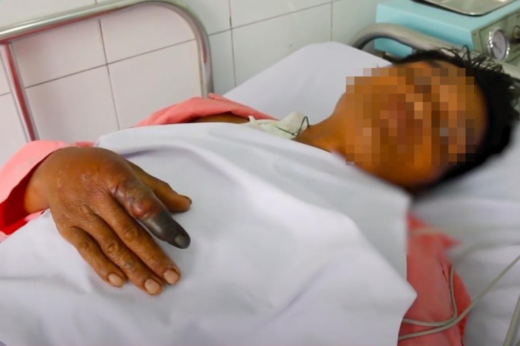 người đàn ông bị rắn hổ mang cắn ảnh 1 nguoi dan ong bi ran ho mang can anh 1