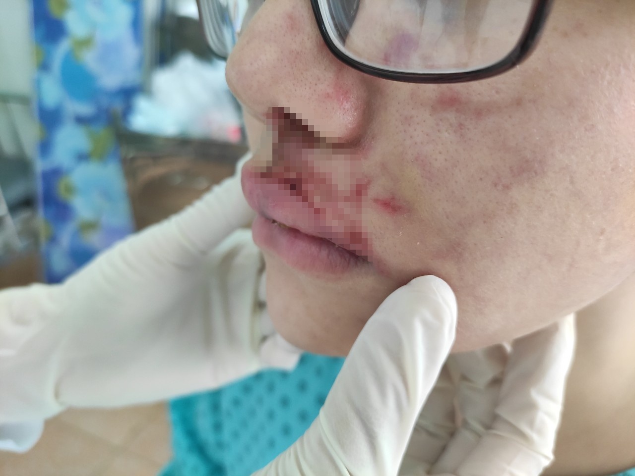 Mat bi mung mu vi tiem filler hinh anh