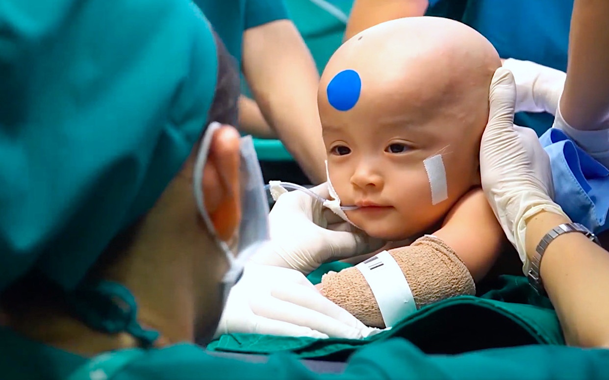 Ca mo tach Truc Nhi, Dieu Nhi la ky luc cua Viet Nam hinh anh