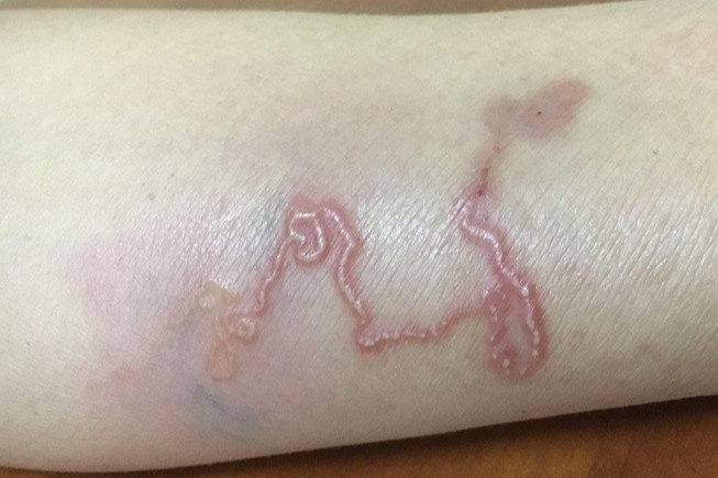 Benh nhan bi giun luon lam to o dui hinh anh