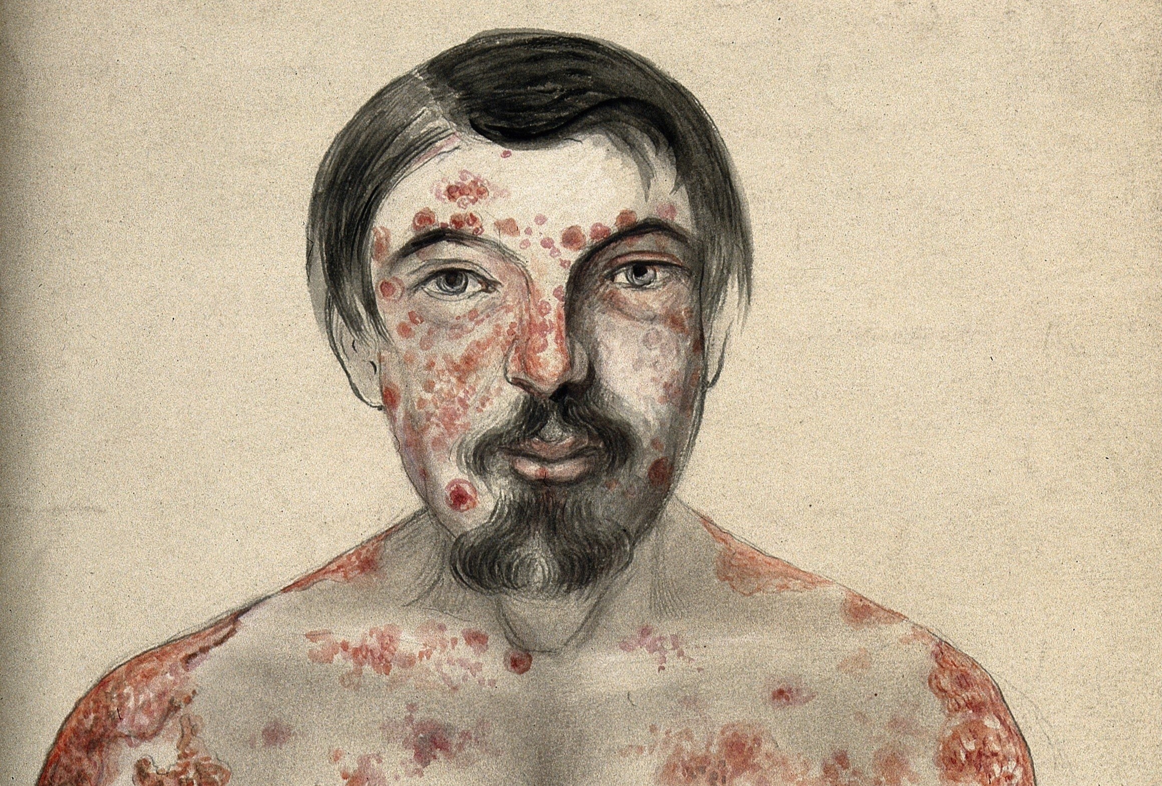 Benh giang mai tai xuat phuc tap hinh anh