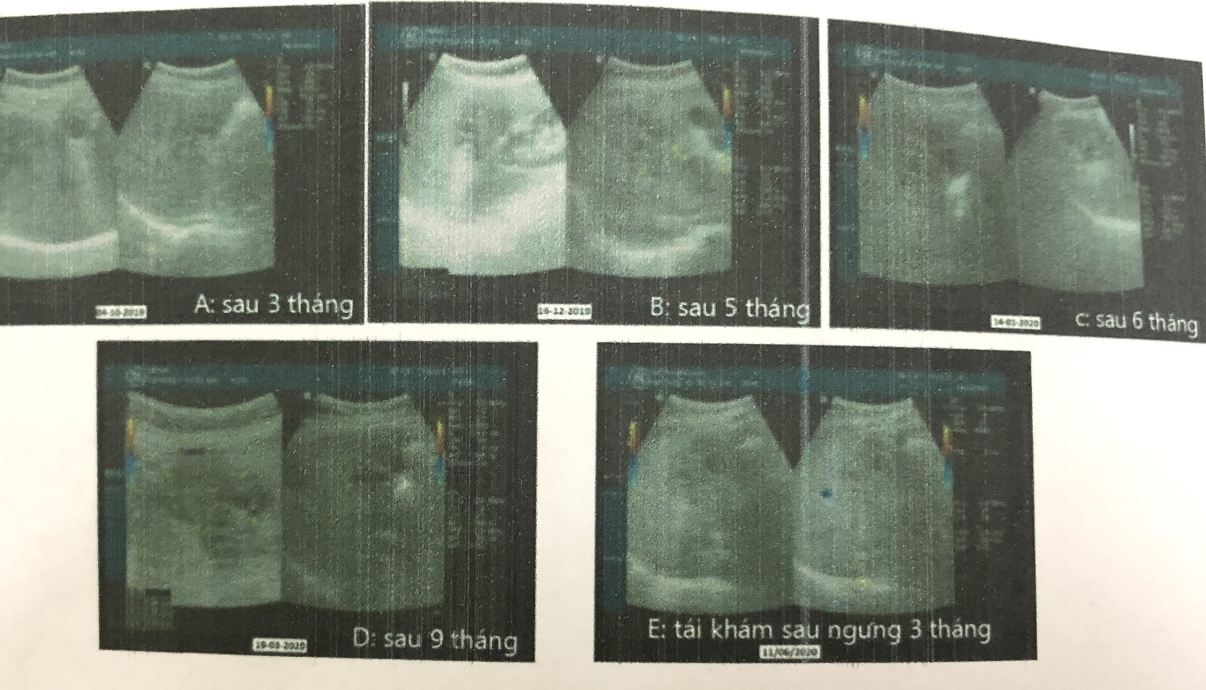 bệnh nhân mắc lao gan hồi cứu y văn ảnh 1 benh nhan mac lao gan hoi cuu y van anh 1