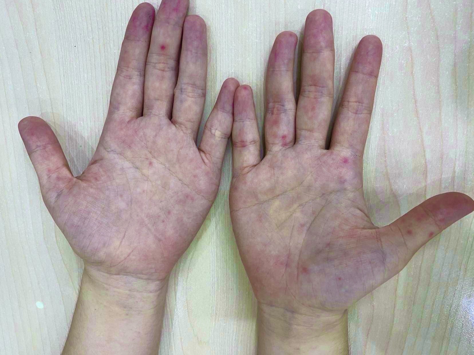 Nguoi phu nu 32 tuoi mac benh tay chan mieng hinh anh