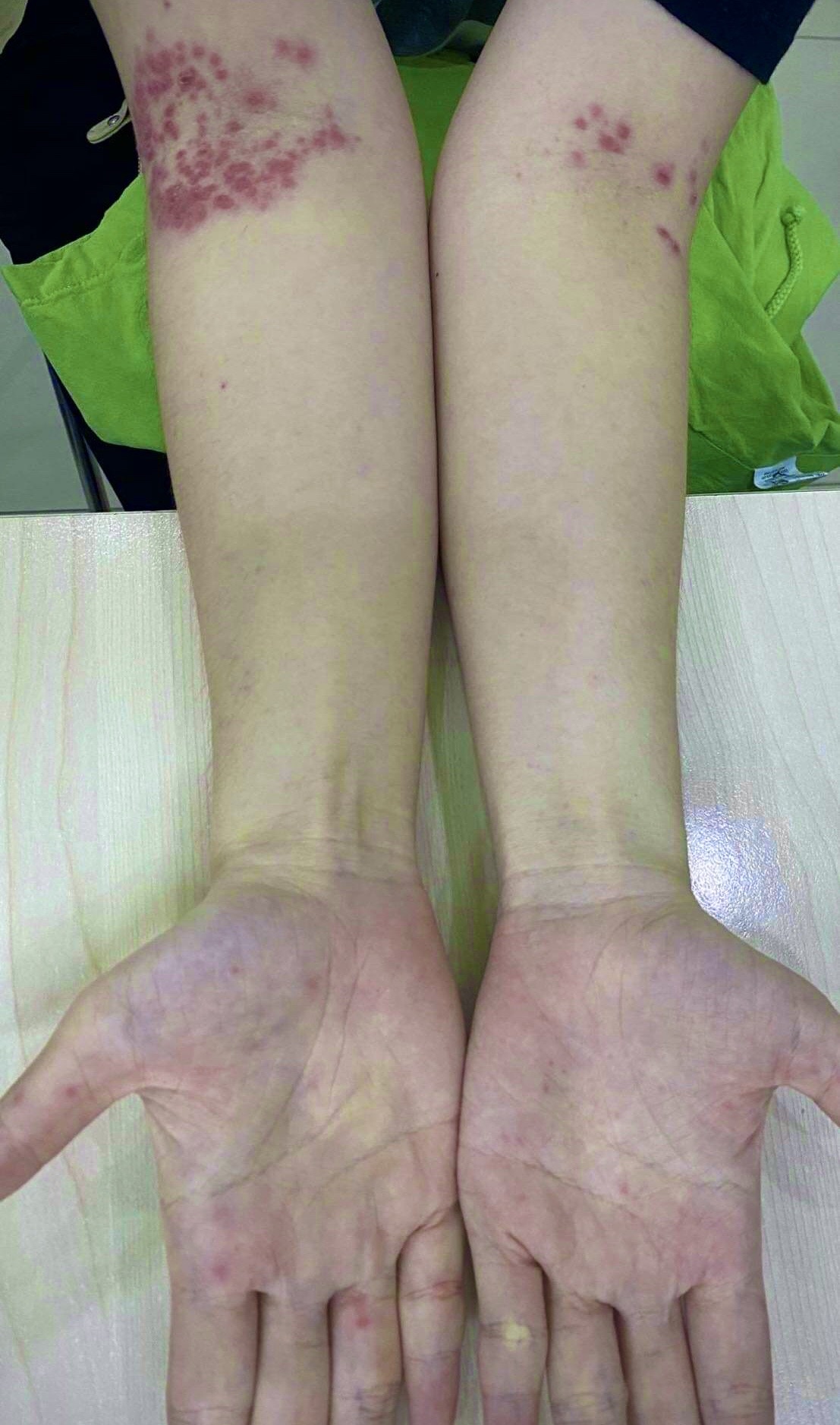 nguoi phu nu mac benh tay chan mieng anh 1