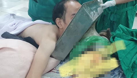 Benh nhan bi coi xay thit nghien nat canh tay hinh anh