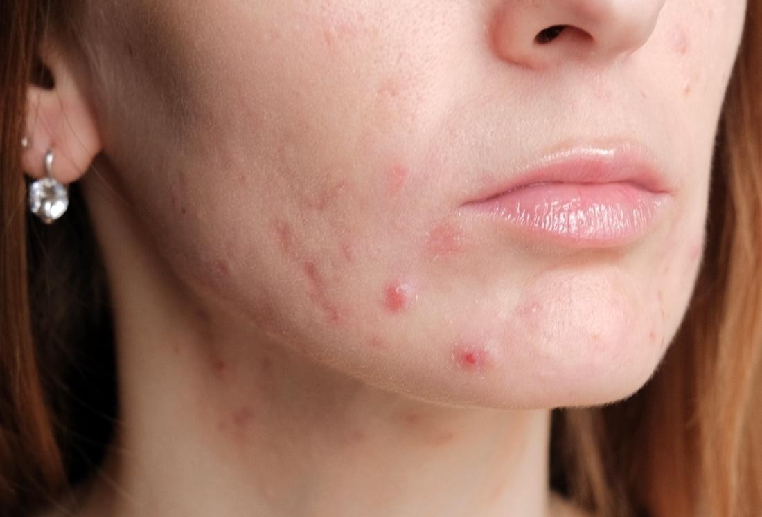 5 ngo nhan ve mun trung ca hinh anh