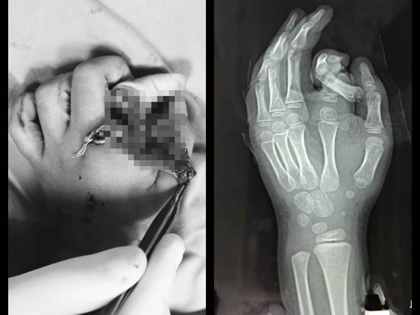 be trai bi dut lia ngon tay do may giat anh 1