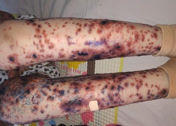 nhung can benh la lung o Viet Nam anh 3