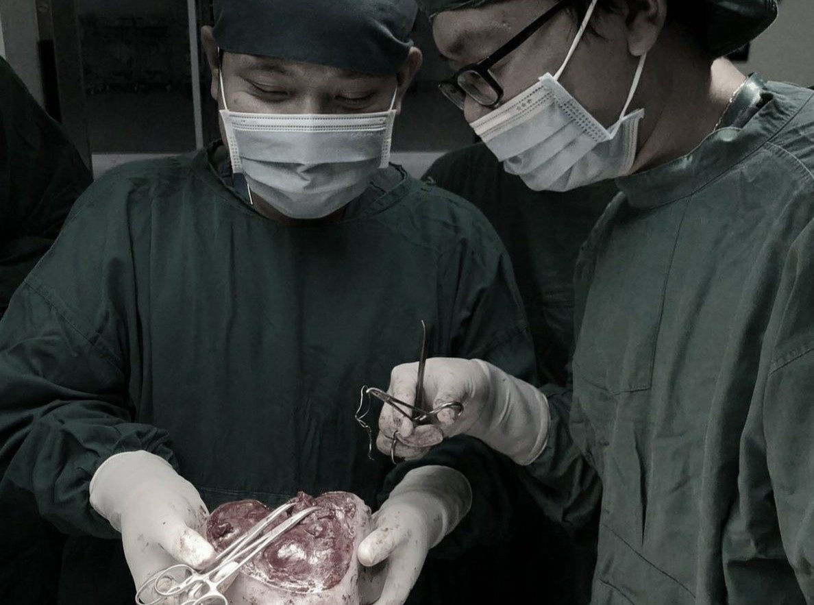 Phau thuat cat khoi u nang mot kg cho be so sinh hinh anh