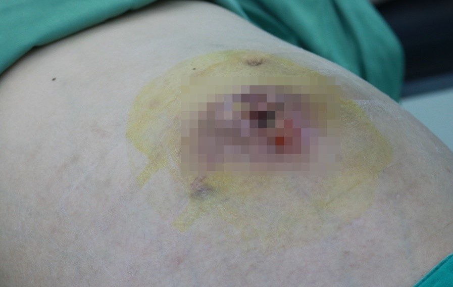 chua u xo tai phong kham tu anh 1