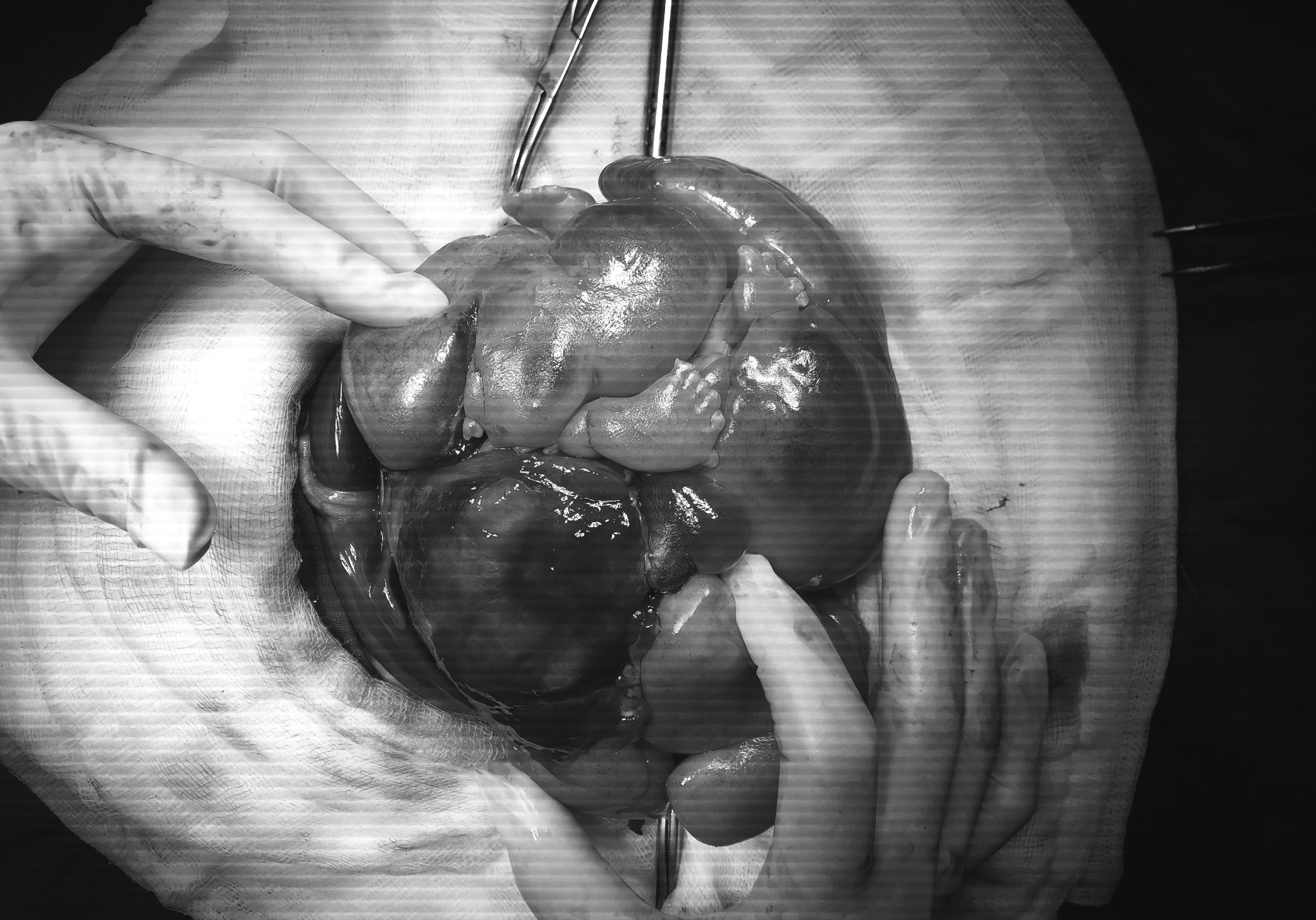 be gai mac hoi chung thai trong thai anh 1