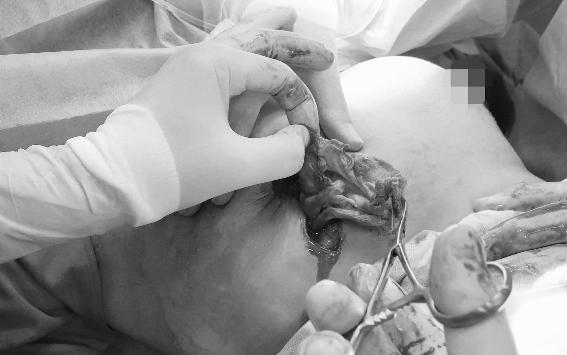 spa bỏ quên gạc trong ngực bệnh nhân ảnh 2 spa bo quen gac trong nguc benh nhan anh 2