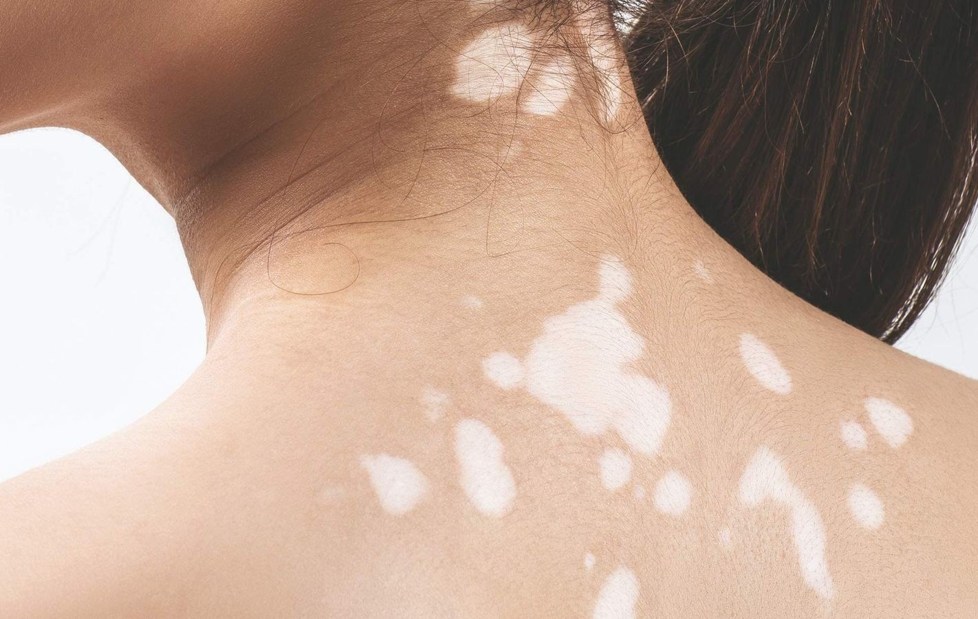 Nguyen nhan gay lang ben hinh anh