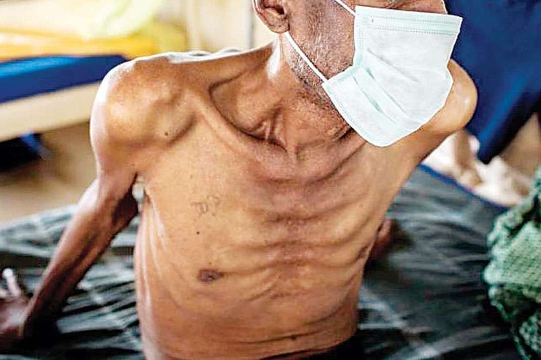 Ai co nguy co cao mac benh lao? hinh anh