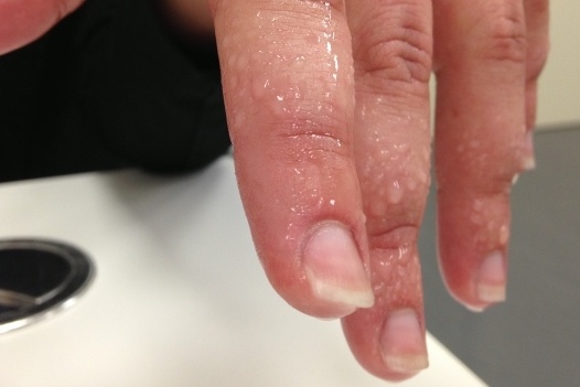 Can benh khien nguoi mac do nhieu mo hoi anh 2