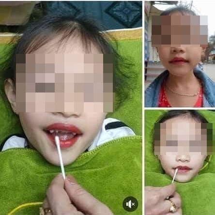thẩm mỹ viện phun môi cho bé 5 tuổi ảnh 2 tham my vien phun moi cho be 5 tuoi anh 2