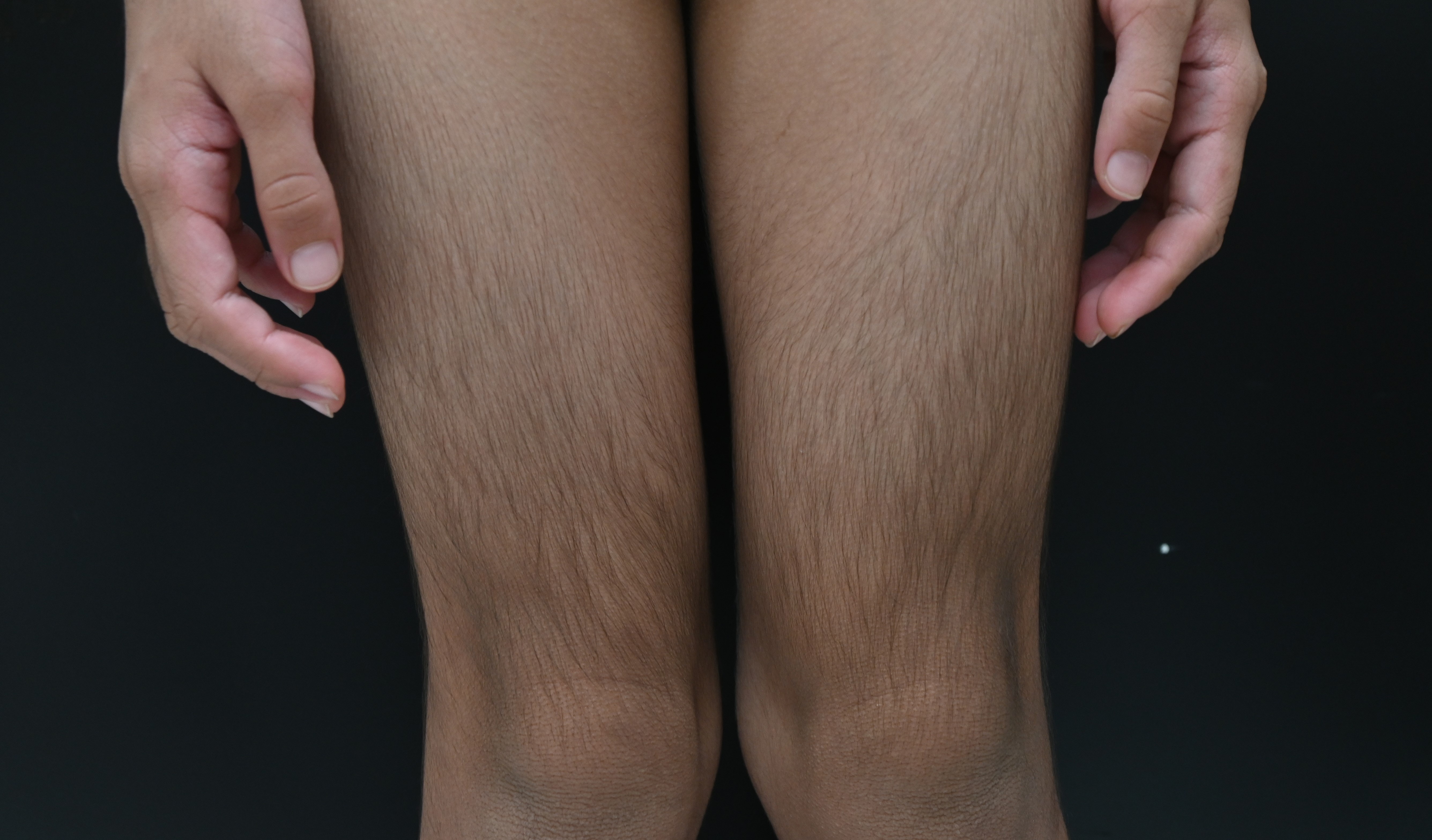 Them 2 nguoi Viet Nam mac benh hiem gap tren the gioi hinh anh