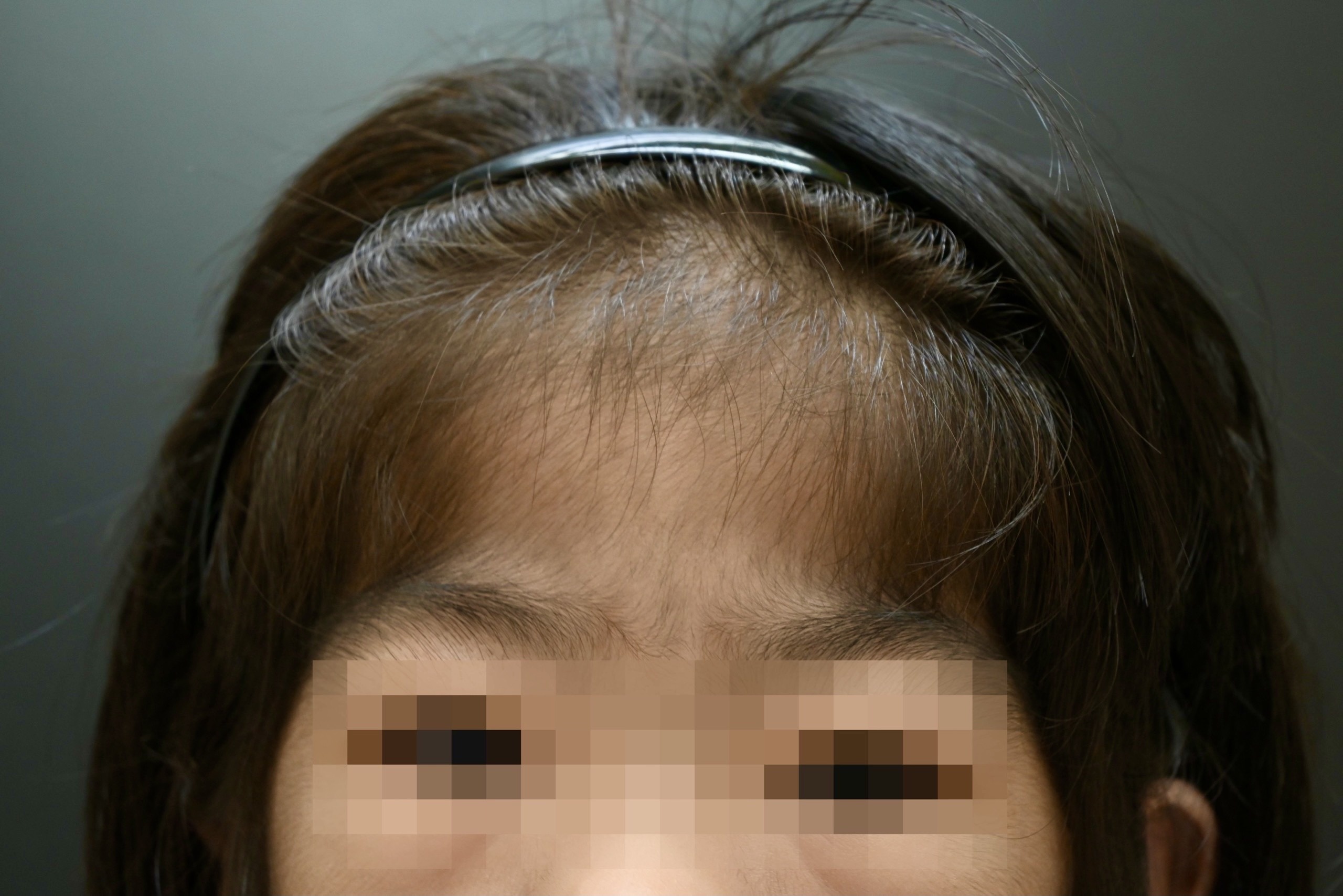 Thêm 2 người Việt Nam mắc bệnh Cantú ảnh 1 Them 2 nguoi Viet Nam mac benh Cantu anh 1