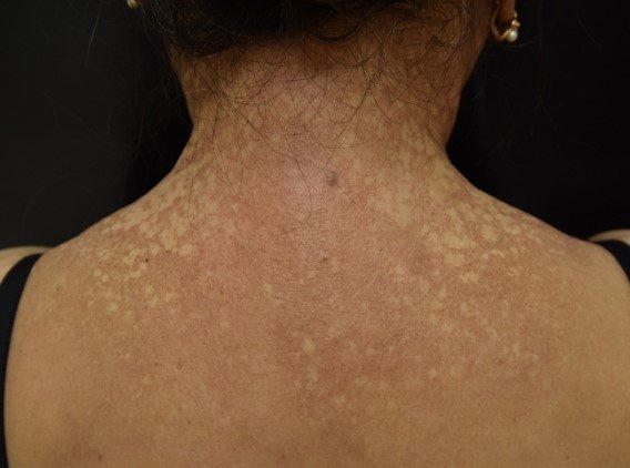 Nguoi phu nu o TP.HCM mac benh hiem khien toc rung nua dau hinh anh