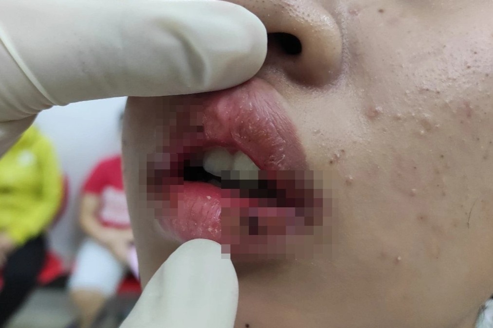 Moi nu sinh chay mu sau khi dung son re tien anh 1