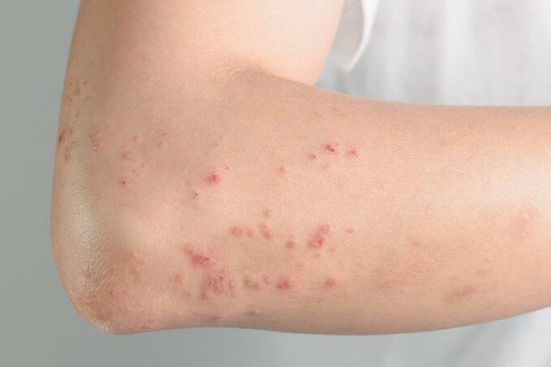 Toan than noi man do, nguoi dan ong duoc phat hien mac giang mai hinh anh