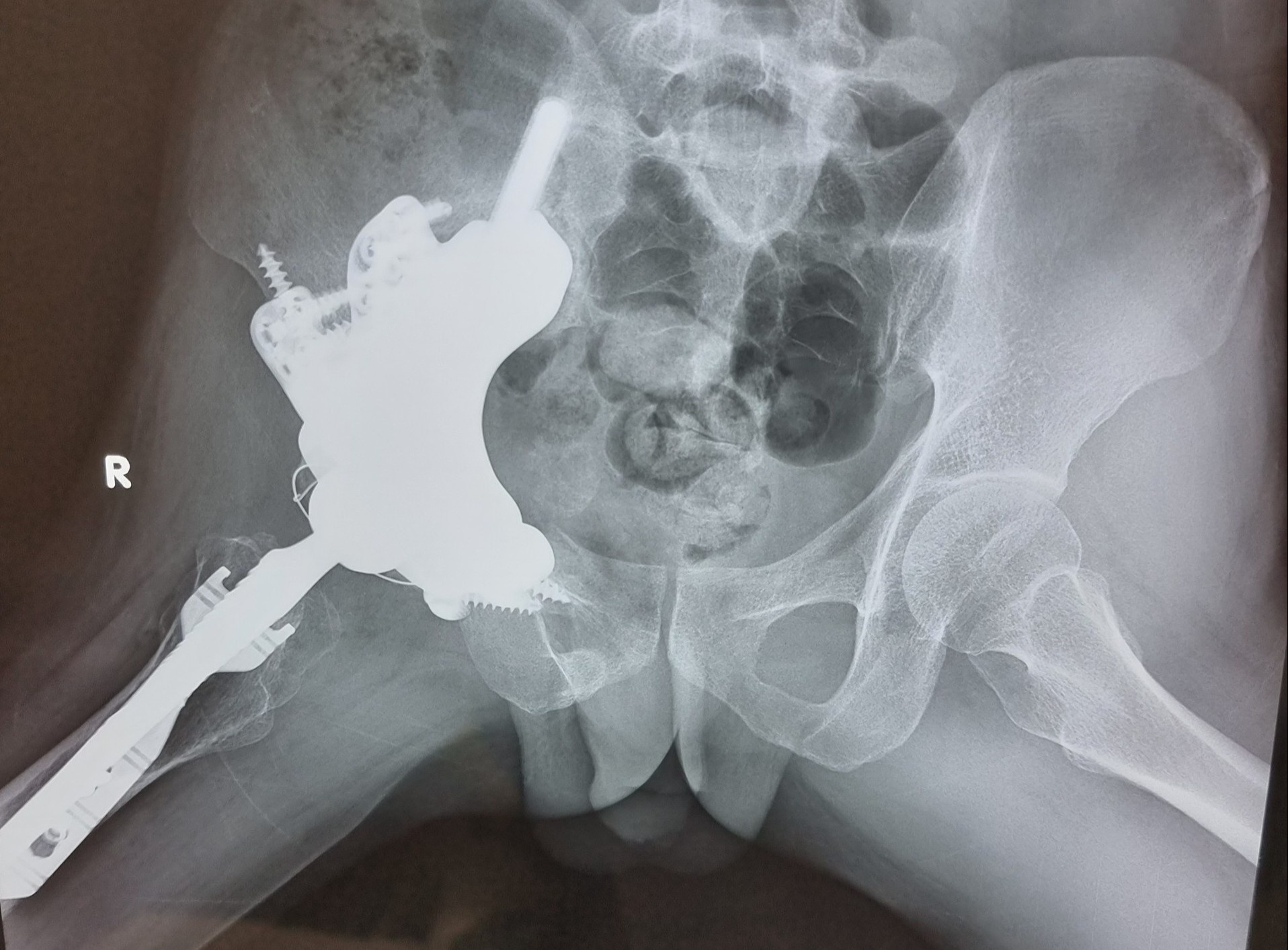 khop hang bang titanium anh 3