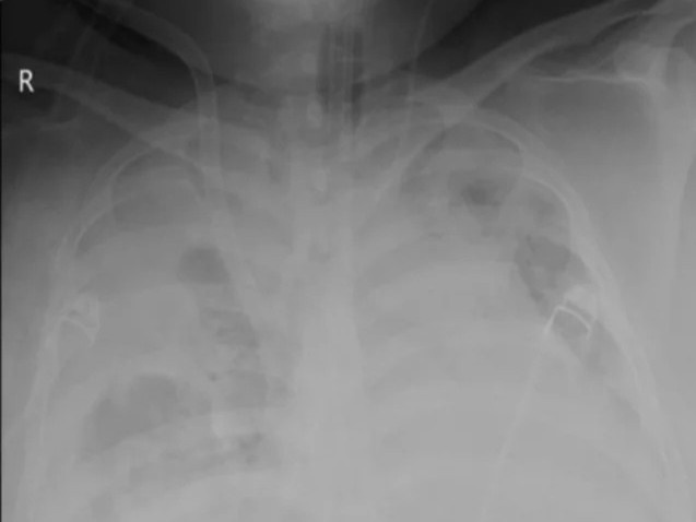 benh nhan khoi Covid-19 anh 1