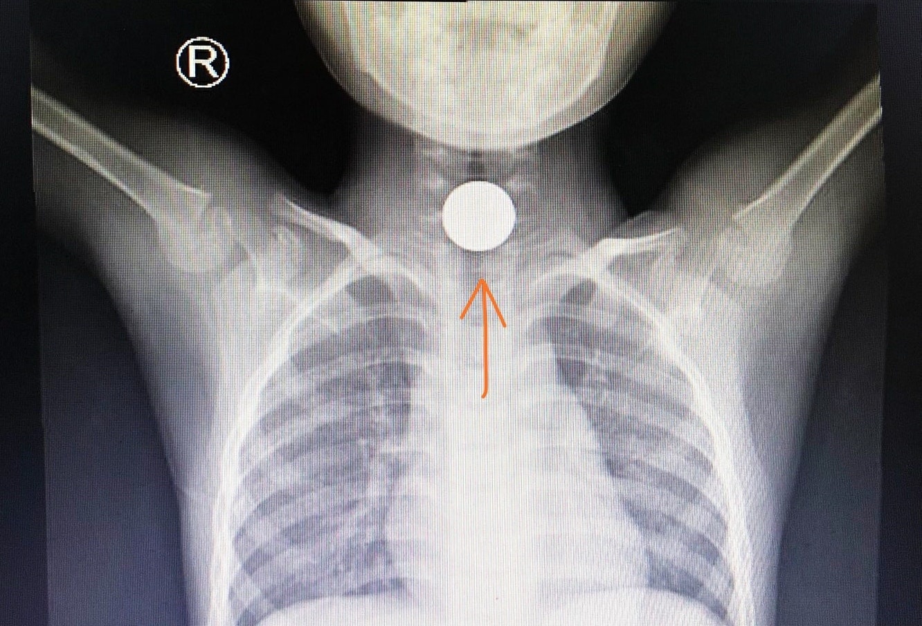 trẻ nhập viện ngày Tết do tai nạn nghiêm trọng  ảnh 2 tre nhap vien ngay Tet do tai nan nghiem trong anh 2