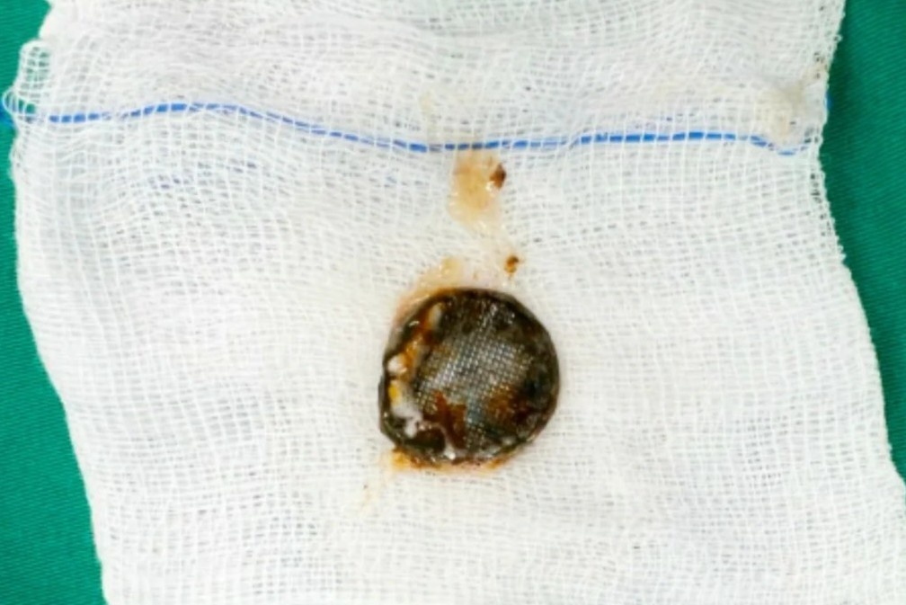 Be trai bi bong thuc quan do nuot pin hinh anh