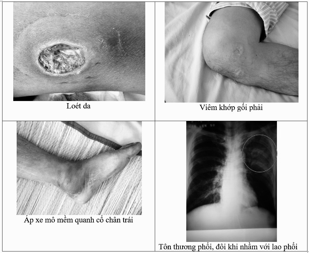 Vi khuan gay benh Whitmore anh 2