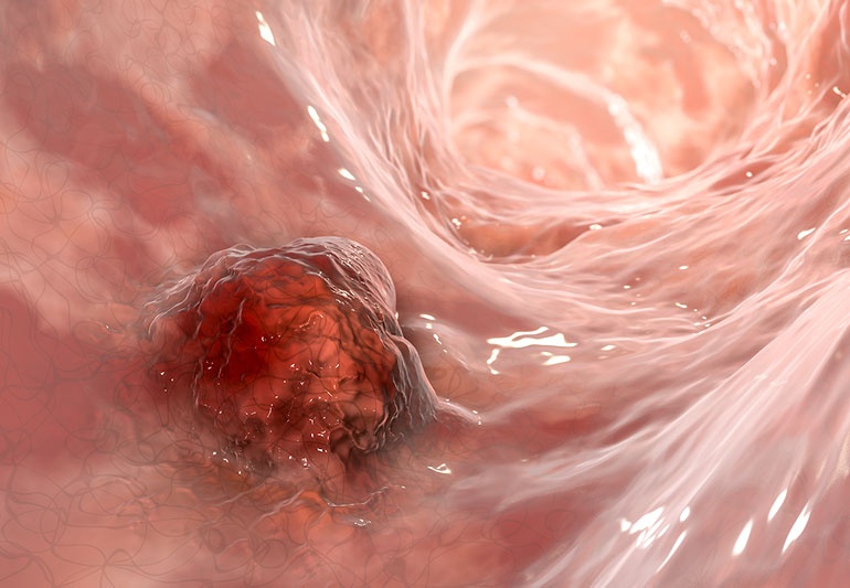 Yeu to khien nhieu nguoi mac ung thu dai truc trang hinh anh