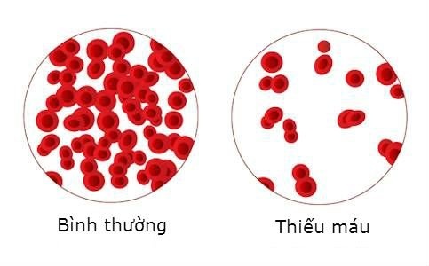 dấu hiệu bệnh thiếu máu  ảnh 1 dau hieu benh thieu mau anh 1