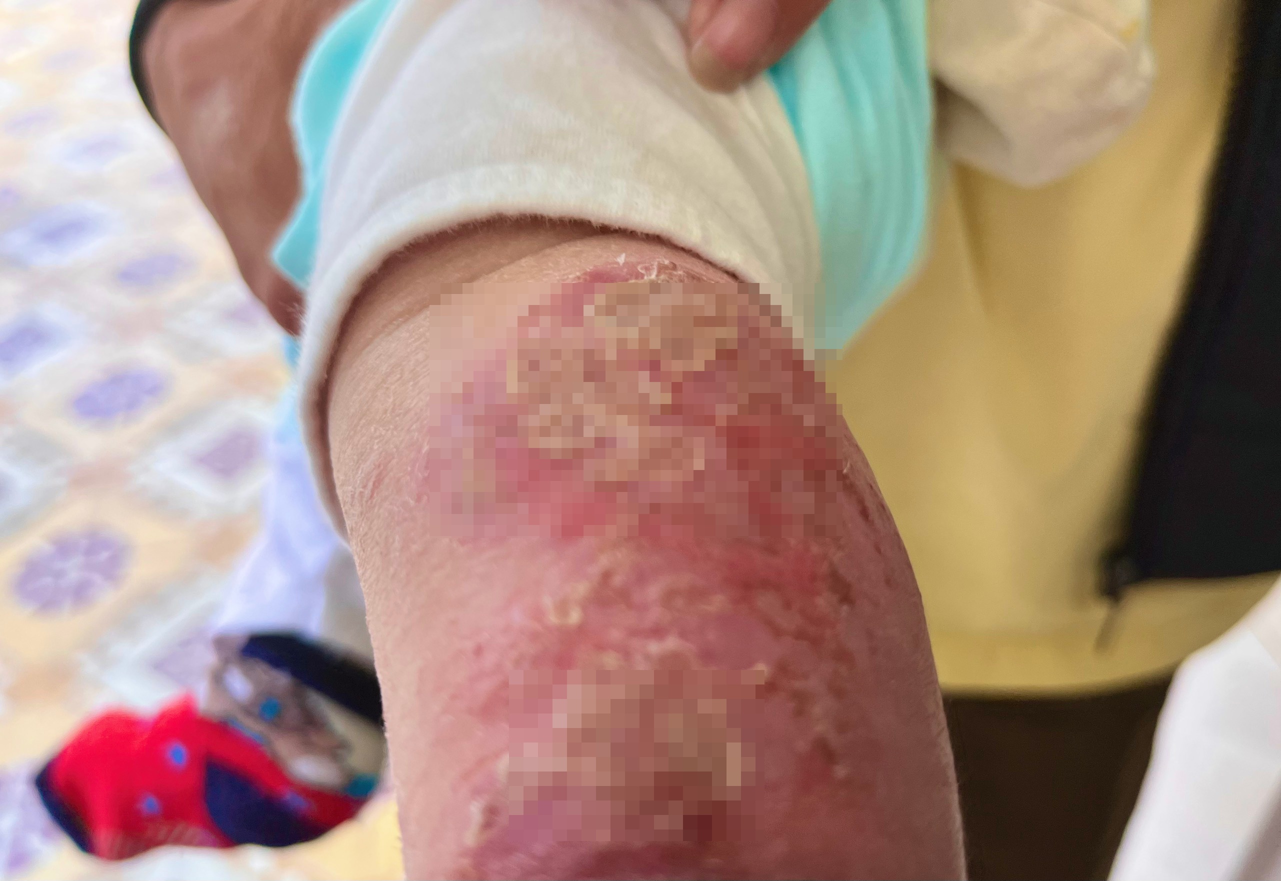 be bi cham sua anh 1